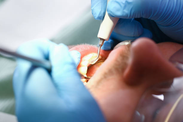 Best Emergency Treatment for Oral Infections in Davenport, IA